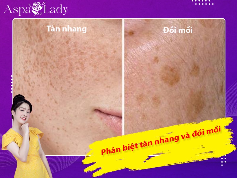 Phân biệt tàn nhang và đồi mồi Phân biệt tàn nhang và đồi mồi