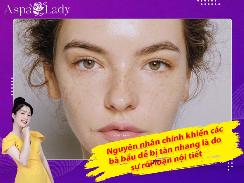 Nguyên nhân chính khiến các bà bầu dễ bị tàn nhang là do sự rối loạn nội tiết Nguyên nhân chính khiến các bà bầu dễ bị tàn nhang là do sự rối loạn nội tiết
