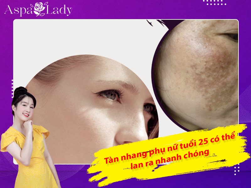 Tàn nhang phụ nữ tuổi 25 có thể lan ra nhanh chóng Tàn nhang phụ nữ tuổi 25 có thể lan ra nhanh chóng