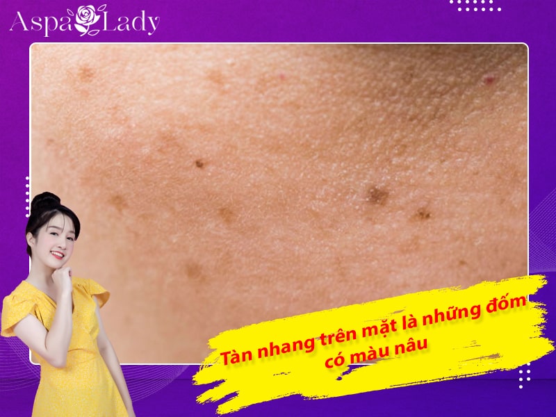 Tàn nhang trên mặt là những đốm có màu nâu Tàn nhang trên mặt là những đốm có màu nâu