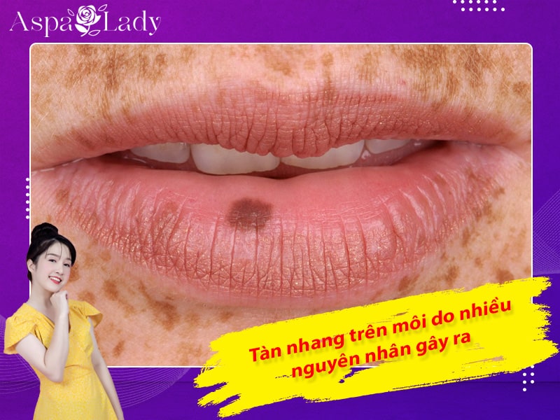 Tàn nhang trên môi do nhiều nguyên nhân gây ra Tàn nhang trên môi do nhiều nguyên nhân gây ra