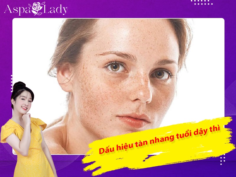 Dấu hiệu tàn nhang tuổi dậy thì Dấu hiệu tàn nhang tuổi dậy thì