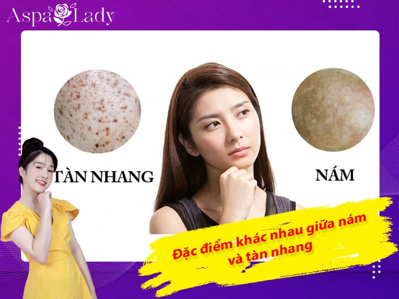 Đặc điểm khác nhau giữa nám và tàn nhang Đặc điểm khác nhau giữa nám và tàn nhang