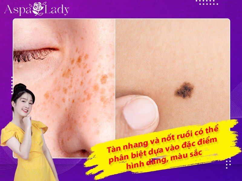 àn nhang và nốt ruồi có thể phân biệt dựa vào đặc điểm hình dáng, màu sắc àn nhang và nốt ruồi có thể phân biệt dựa vào đặc điểm hình dáng, màu sắc