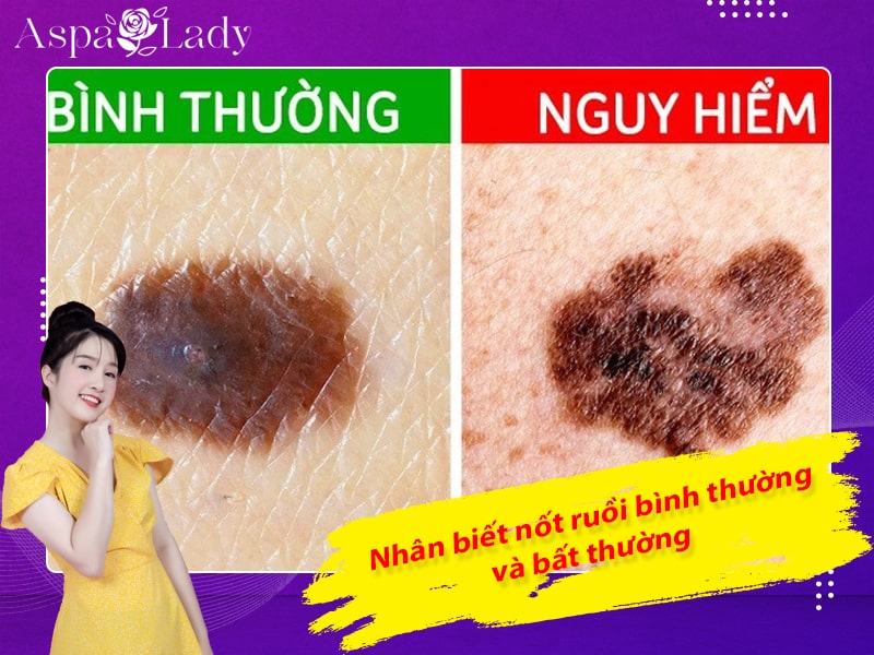 Nhận biết nốt ruồi bình thường và bất thường Nhận biết nốt ruồi bình thường và bất thường
