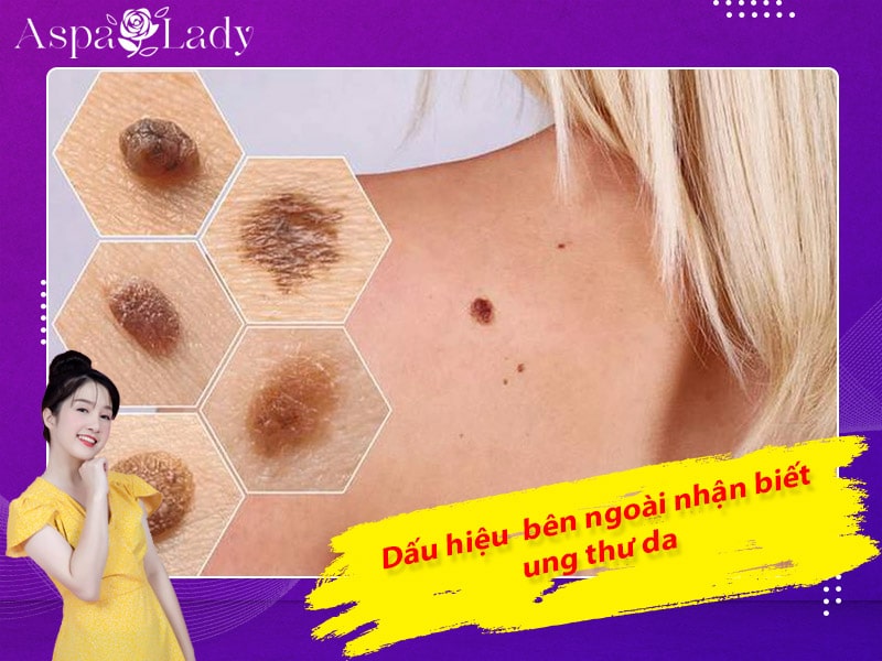 Dấu hiệu bên ngoài nhận biết ung thư da Dấu hiệu bên ngoài nhận biết ung thư da