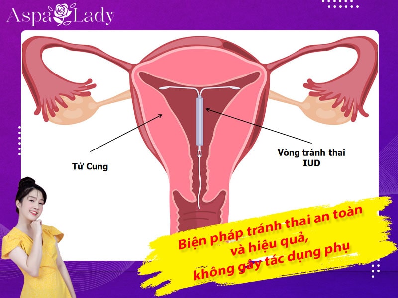 Biện pháp tránh thai an toàn hiệu quả, không gây tác dụng phụ