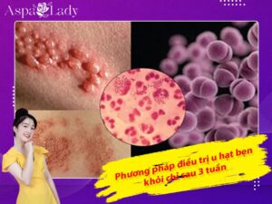 Phương pháp điều trị u hạt bẹn khỏi chỉ sau 3 tuần