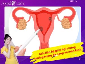 Mối liên hệ giữa hội chứng buồng trứng đa nang và mãn kinh
