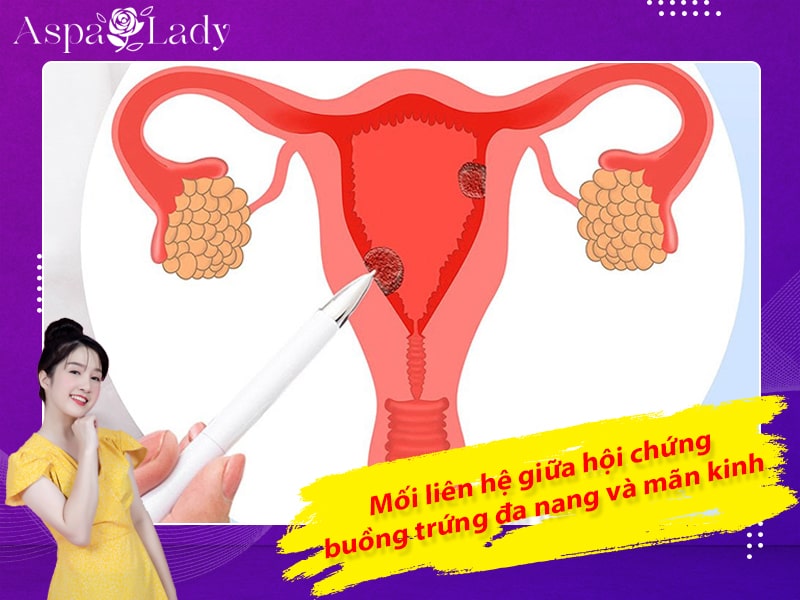 Mối liên hệ giữa hội chứng buồng trứng đa nang và mãn kinh