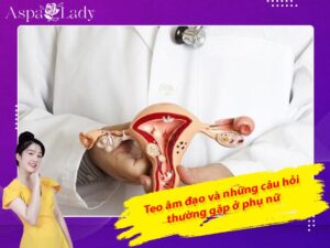 Teo âm đạo (GSM) và những câu hỏi thường gặp ở phụ nữ