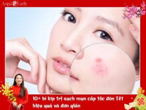 10+ bí kíp trị sạch mụn cấp tốc đón Tết hiệu quả và đơn giản