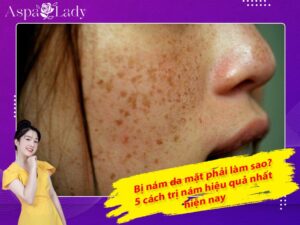 Bị nám da mặt phải làm sao? 5 cách trị nám hiệu quả nhất hiện nay
