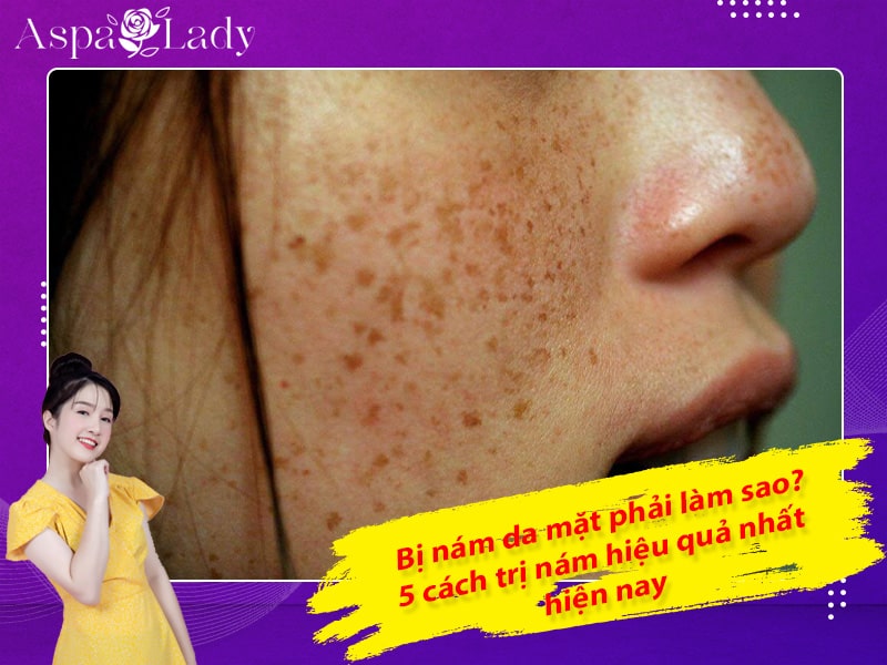 Bị nám da mặt phải làm sao? 5 cách trị nám hiệu quả nhất hiện nay