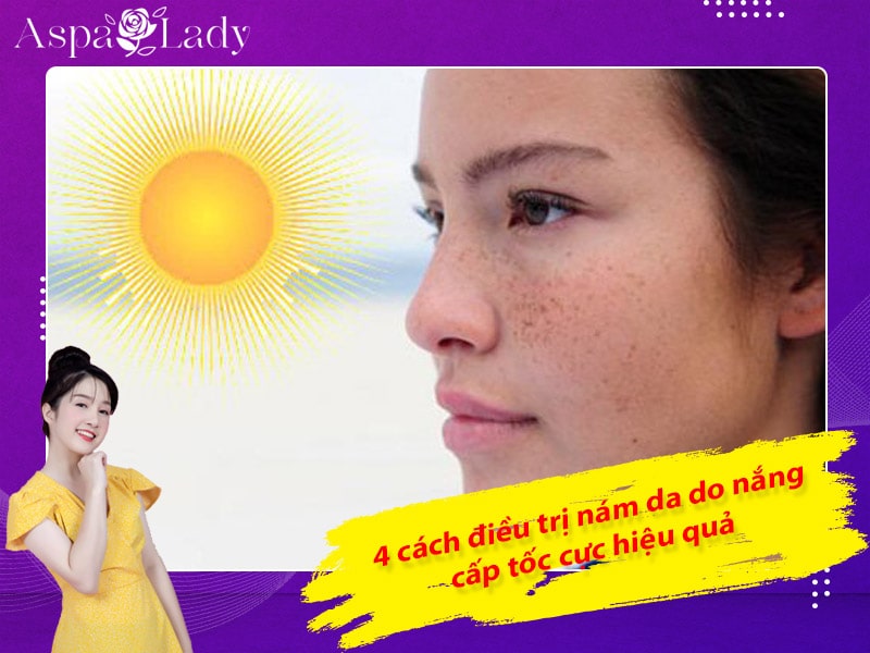 4 cách điều trị nám da do nắng cấp tốc cực hiệu quả