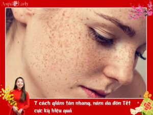 7 cách giảm tàn nhang, nám da đón Tết cực kỳ hiệu quả