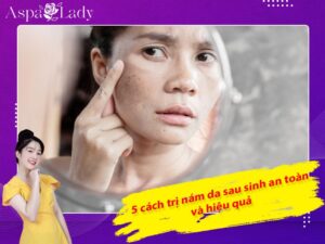 5 cách trị nám da sau sinh an toàn và hiệu quả