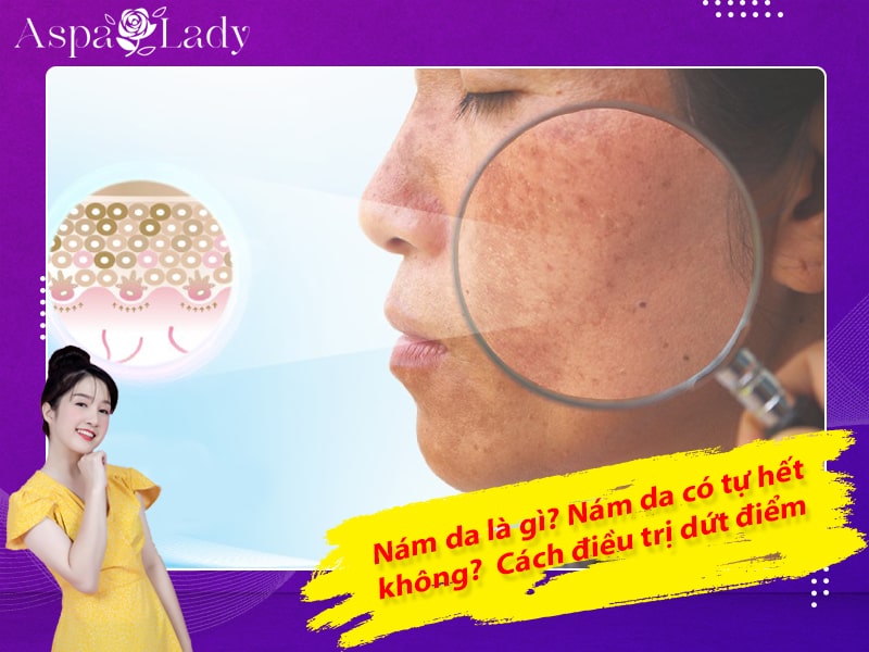 Nám da là gì? Nám da có tự hết không? Cách điều trị dứt điểm