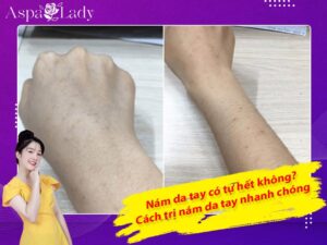 Nám da tay có tự hết không? Cách trị nám da tay nhanh chóng