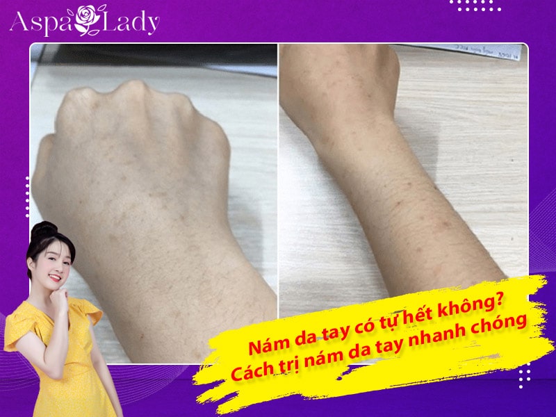 Nám da tay có tự hết không? Cách trị nám da tay nhanh chóng
