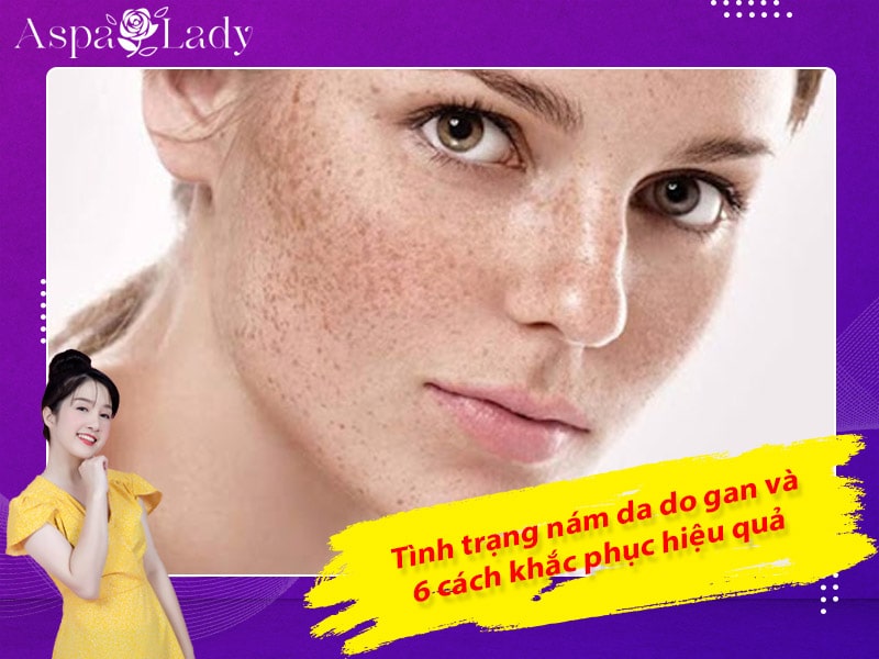 Tình trạng nám da do gan và 6 cách khắc phục hiệu quả