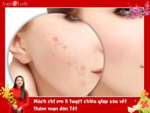 Mách chị em 8 tuyệt chiêu giúp xóa vết thâm mụn đón Tết