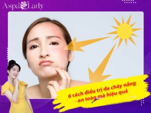 6 cách điều trị da cháy nắng an toàn mà hiệu quả