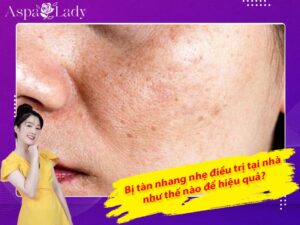 Bị tàn nhang nhẹ điều trị tại nhà như thế nào để hiệu quả?