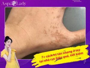 7+ cách trị tàn nhang ở tay tại nhà cực hiệu quả, tiết kiệm