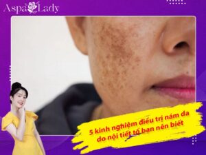 5 kinh nghiệm điều trị nám da do nội tiết tố bạn nên biết