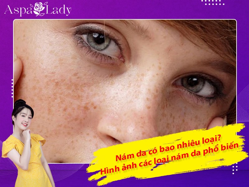 Nám da có bao nhiêu loại? Hình ảnh các loại nám da phổ biến
