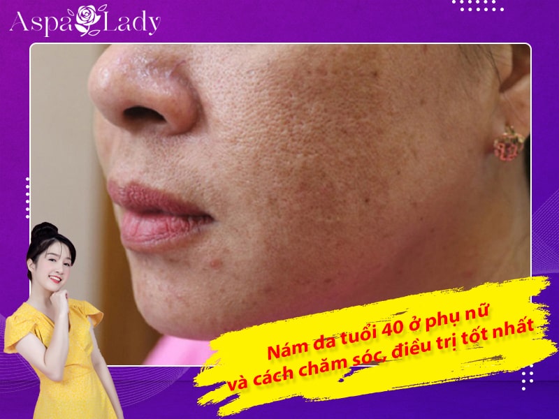 Nám da tuổi 40 ở phụ nữ và cách chăm sóc, điều trị tốt nhất