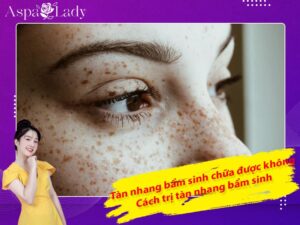 Tàn nhang bẩm sinh có chữa được không? Cách trị tàn nhang bẩm sinh