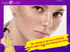 Tàn nhang có bị lan ra không? Cách ngăn chặn tàn nhang lan rộng