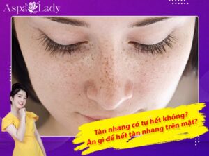 Tàn nhang có tự hết không? Ăn gì để hết tàn nhang trên mặt?