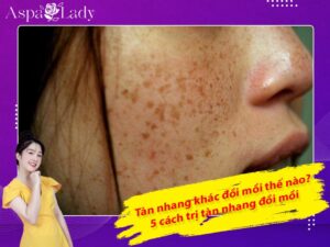Tàn nhang khác đồi mồi thế nào? 5 cách trị tàn nhang đồi mồi