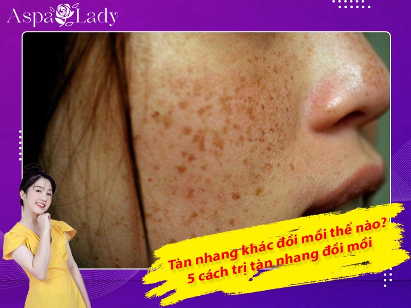 Tàn nhang khác đồi mồi thế nào? 5 cách trị tàn nhang đồi mồi