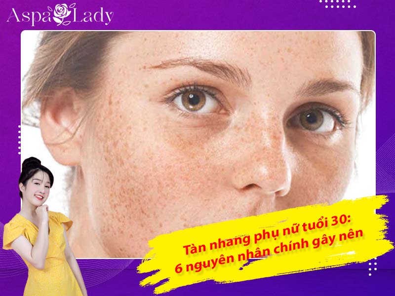 Tàn nhang phụ nữ tuổi 30: 6 nguyên nhân chính gây nên