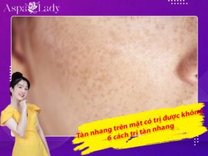 Tàn nhang trên mặt có trị được không? 6 cách trị tàn nhang