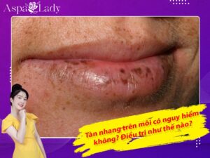 Tàn nhang trên môi có nguy hiểm không? Điều trị như thế nào?