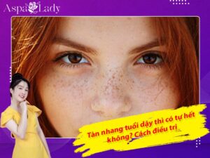 Tàn nhang tuổi dậy thì có tự hết không? Cách điều trị
