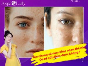 Tàn nhang và nám khác nhau thế nào? Có trị dứt điểm được không?