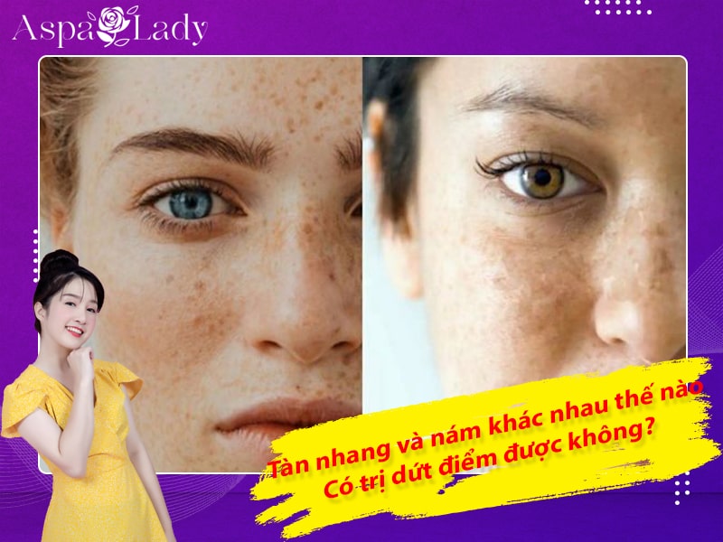 Tàn nhang và nám khác nhau thế nào? Có trị dứt điểm được không?