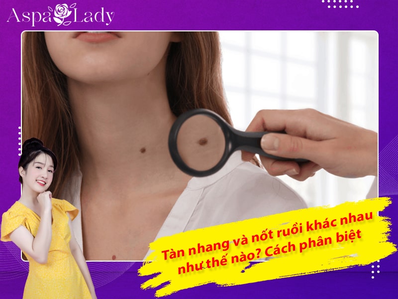 Tàn nhang và nốt ruồi khác nhau như thế nào? Cách phân biệt