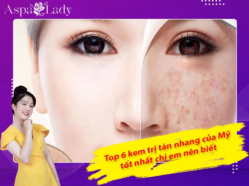 Top 6 kem trị tàn nhang của Mỹ tốt nhất chị em nên biết