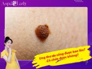 Ung thư da sống được bao lâu? Có chữa được không?