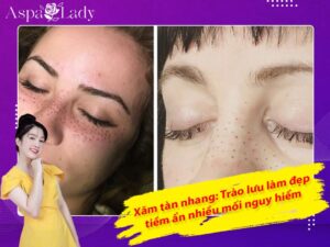 Xăm tàn nhang: Trào lưu làm đẹp tiềm ẩn nhiều mối nguy hiểm